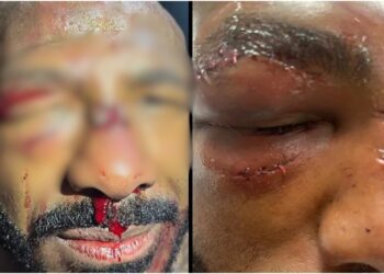 Khalil Rountree visar upp skadorna efter UFC 307 - MMAnytt - 1000x547